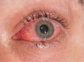 conjunctivitis-pink-eye-678x446