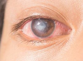 corneal-ulcer-keratitis