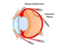 retinal-detachment-illustration2