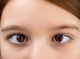 یک نمونه استرابیسم